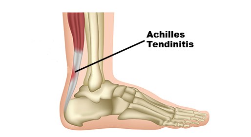 achilles tendinitis