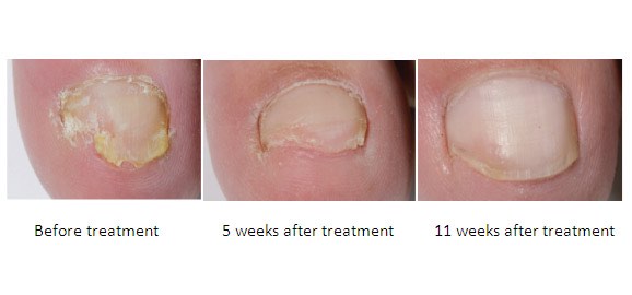 Laser Treatments & Therapy for Fungal Nails in Perth