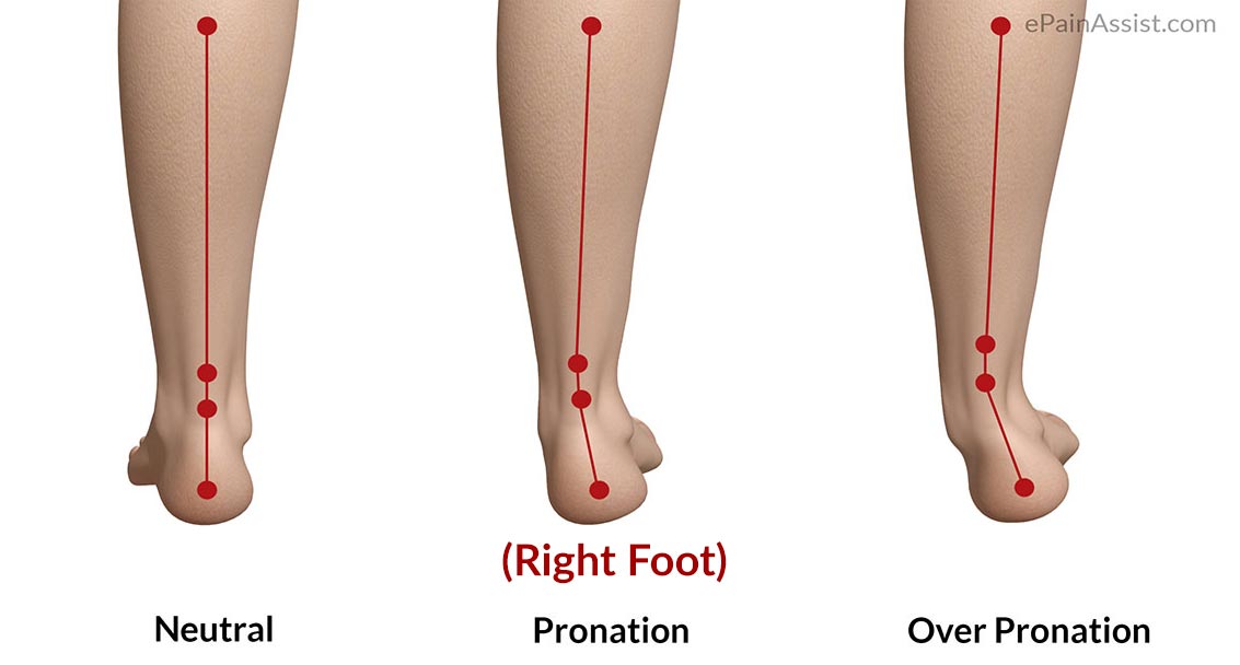 foot pronation