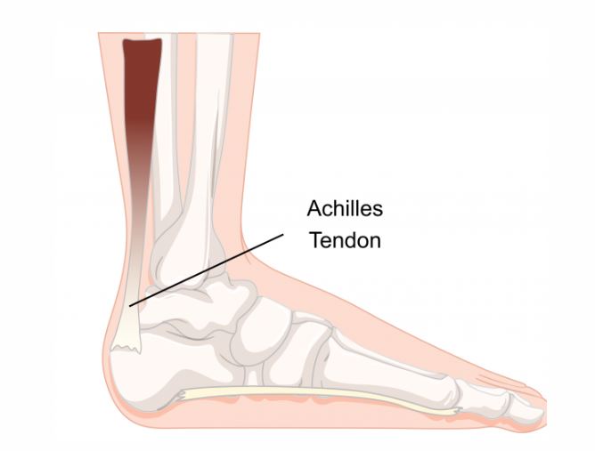Achilles Pain