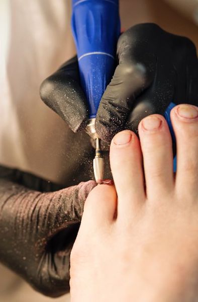 Ingrown Toenail Treatment